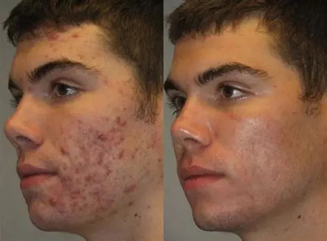Face Reality acne treatment before-and-after facial comparison