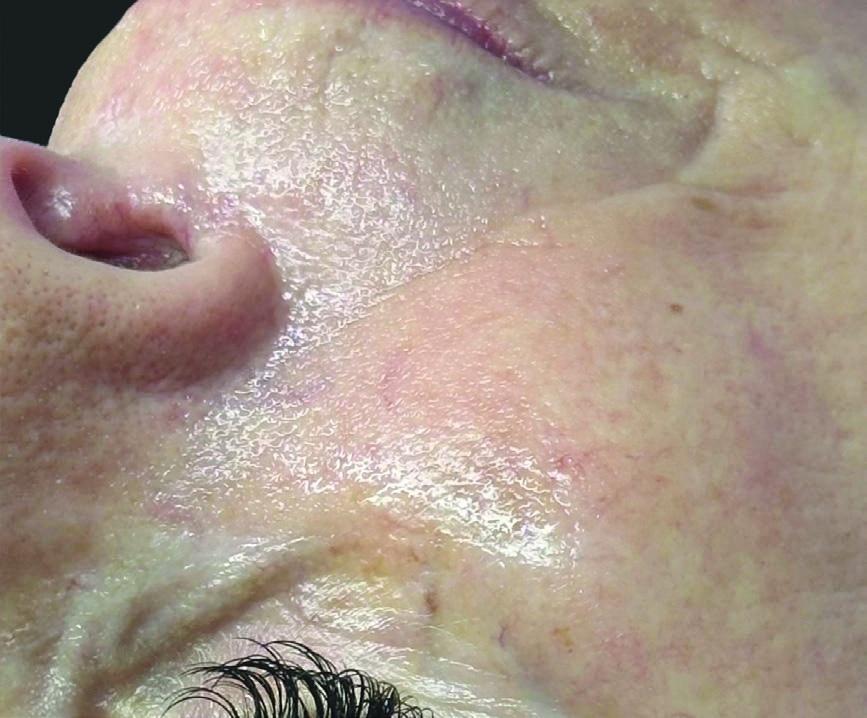 After HydraFacial skin texture and glow result