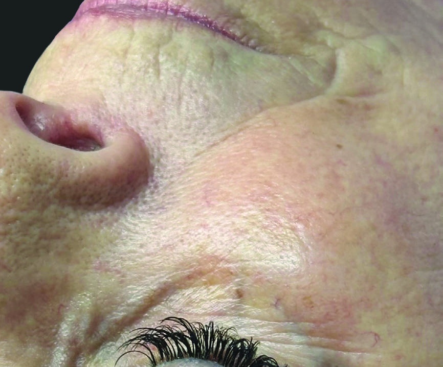 Before HydraFacial skin texture and glow result