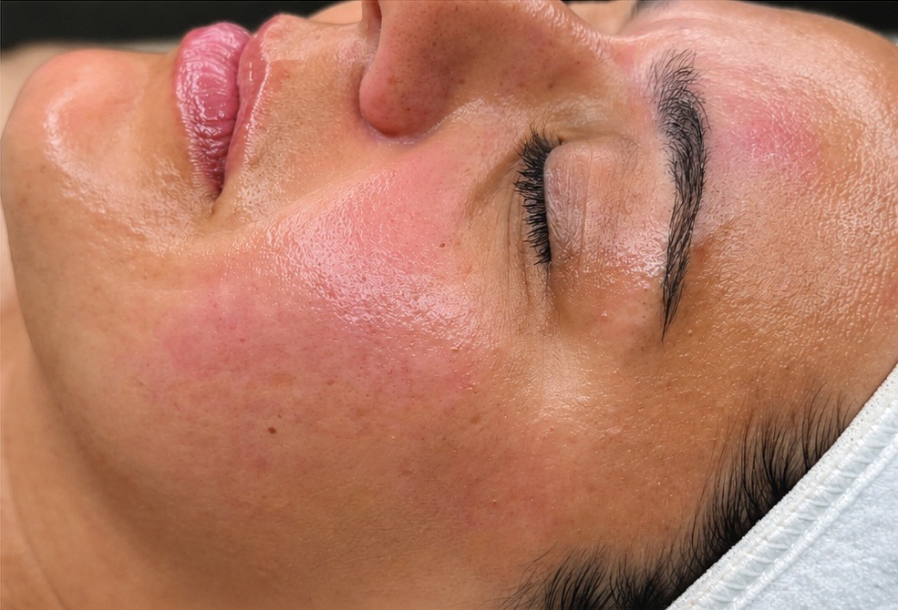 After HydraFacial skin refresh, AI-edited color preview