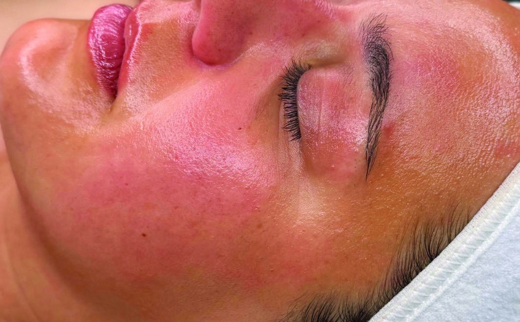 After HydraFacial skin refresh result