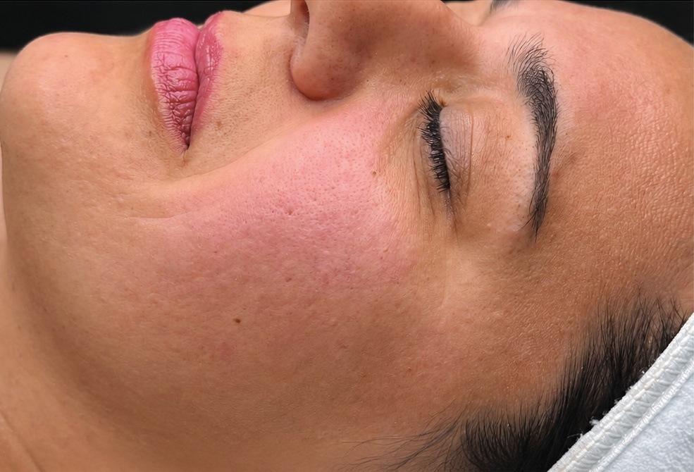 Before HydraFacial skin refresh, AI-edited color preview
