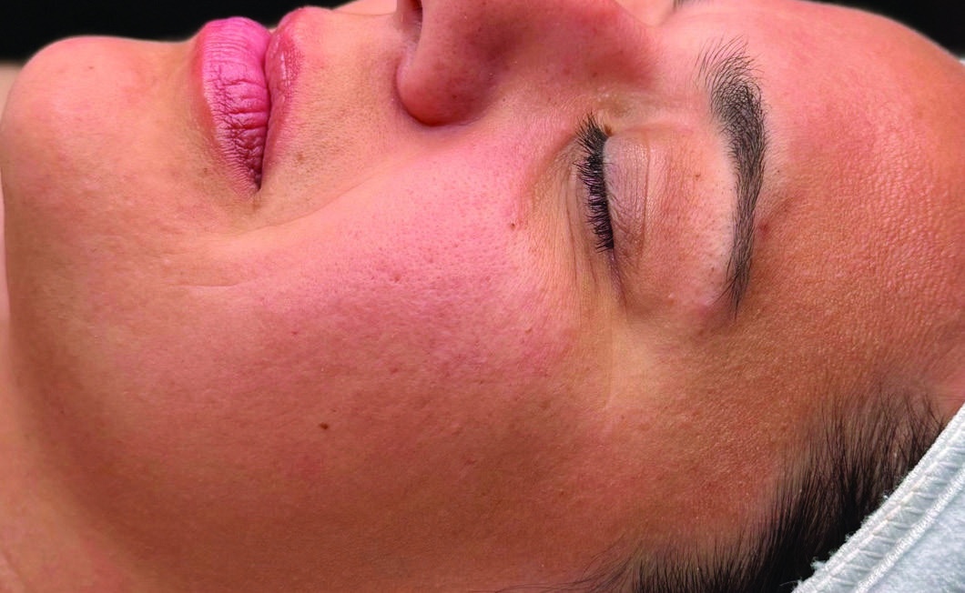 Before HydraFacial skin refresh result