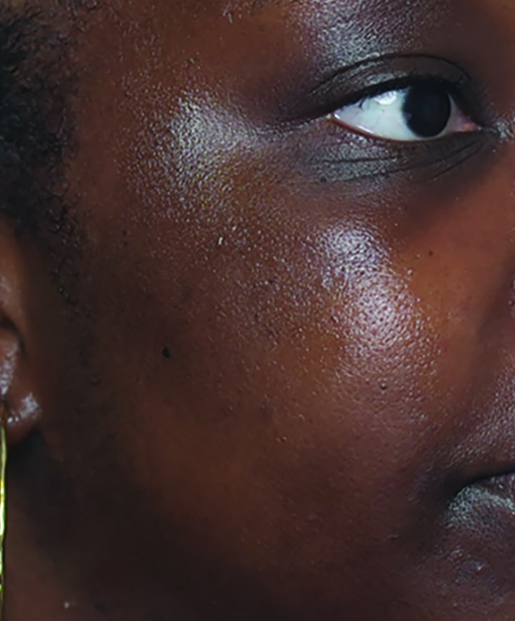 After HydraFacial brightening result