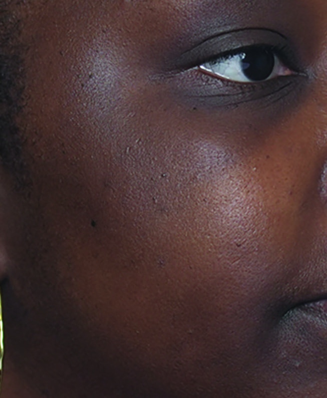 Before HydraFacial brightening result