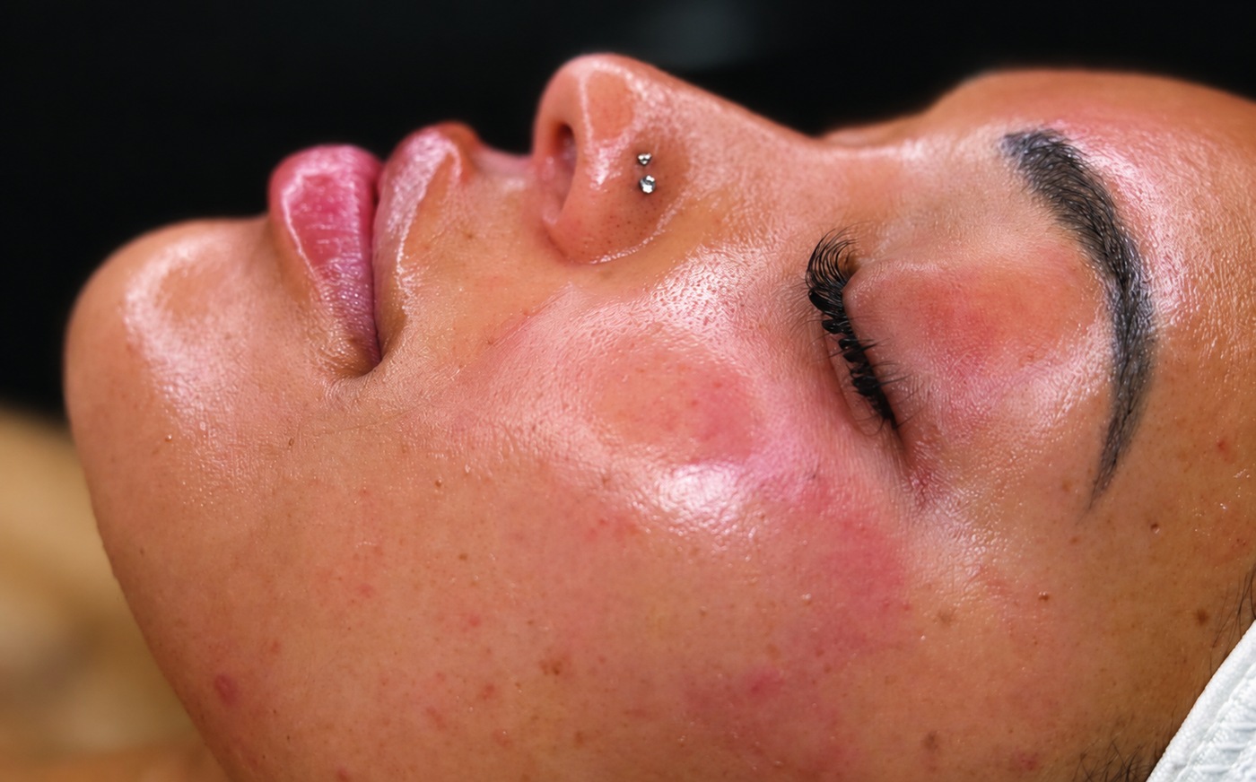 After HydraFacial clarifying, AI-edited color preview