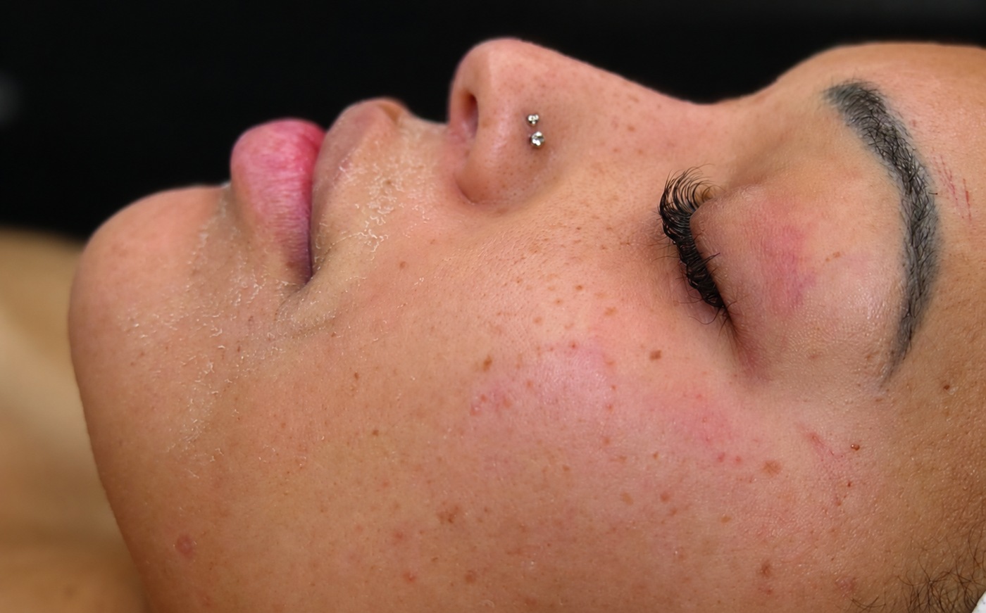 Before HydraFacial clarifying, AI-edited color preview