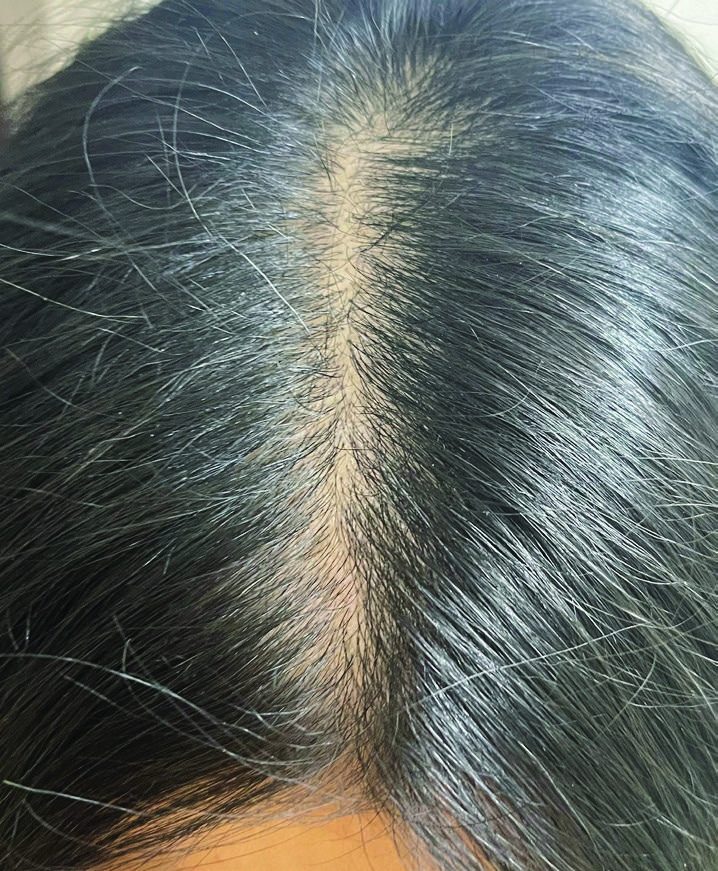 After Scalp treatment progress result
