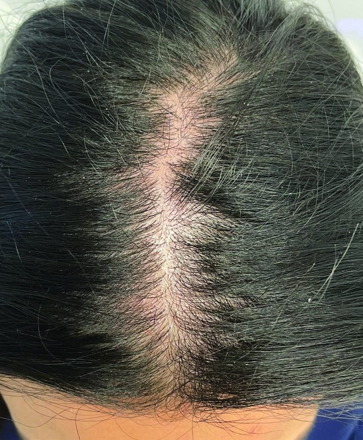 Before Scalp treatment progress result